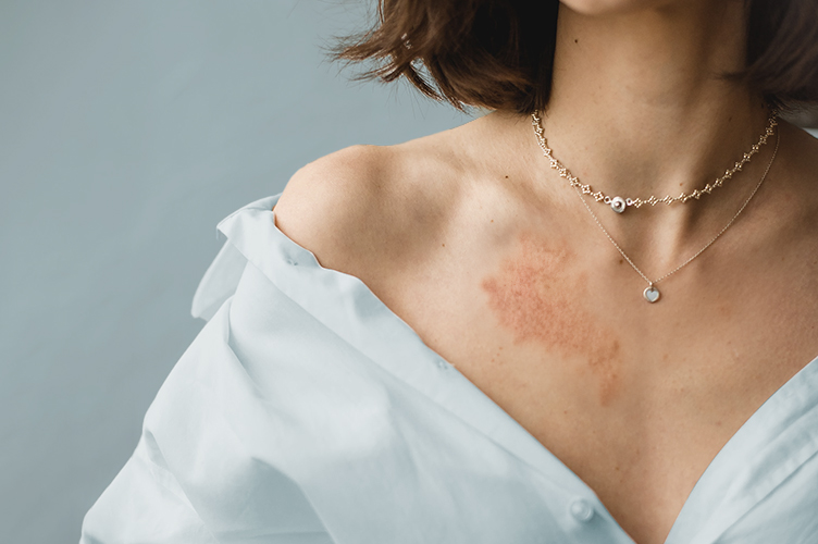 alergi kulit akibat perhiasan
