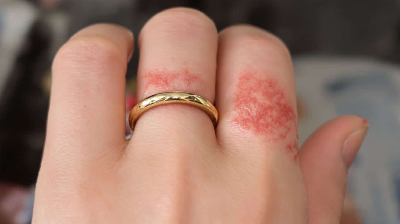 alergi kulit akibat perhiasan mengandung nikel